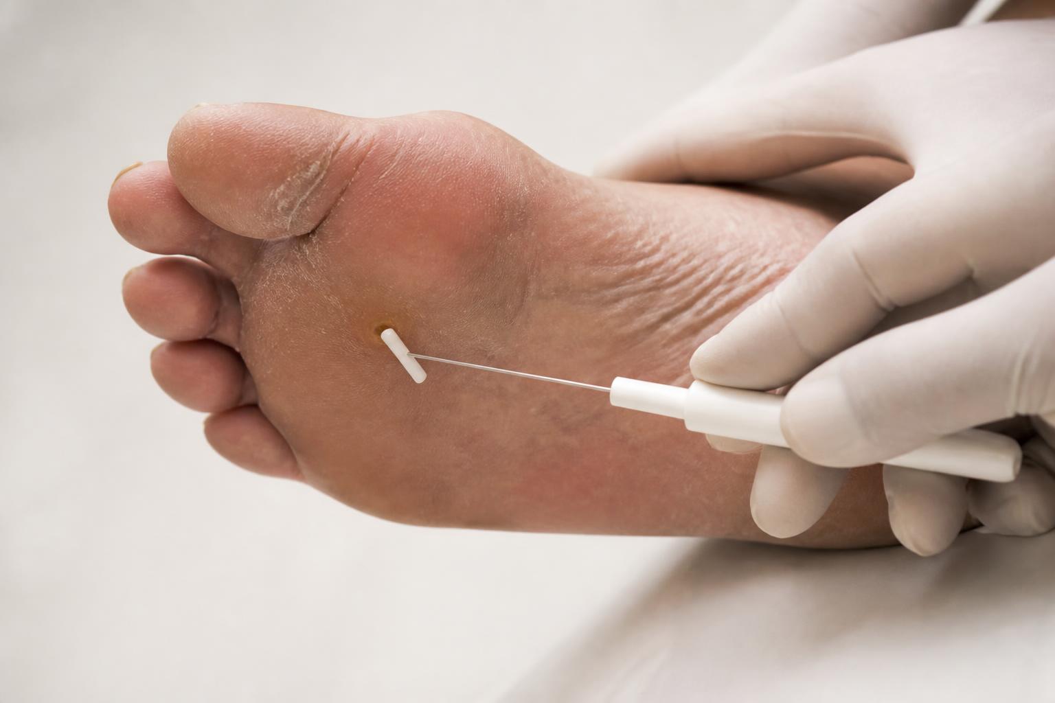 découvrez comment prévenir les complications du pied diabétique grâce à une surveillance rigoureuse et des conseils pratiques pour protéger votre santé au quotidien.